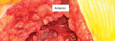 Illustration 15 for Robotics in Total Hip Arthroplasty: A New Era of Precision