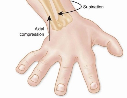 Illustration 9 for Restore Stability & Motion: Fixation of Fracture-Dislocations