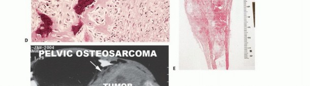 Illustration 36 for Understanding Benign Bone Tumors: Your Complete Preoperative Guide