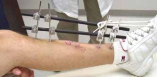 Illustration of fixation of the tibia - Dr. Mohammed Hutaif