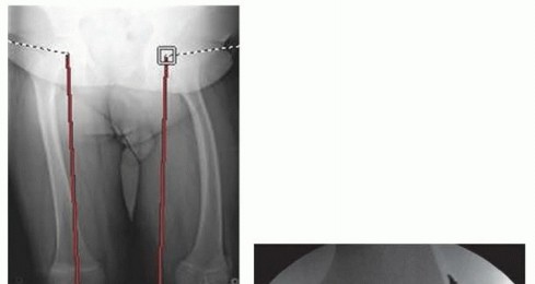 Illustration 17 for Optimizing Growth to Correct Pediatric Limb Deformities