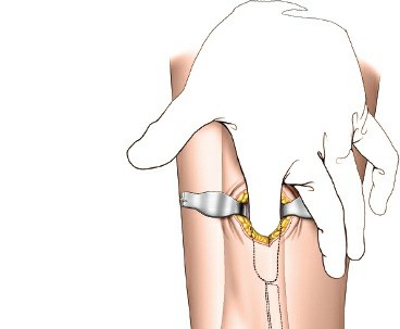 Illustration 68 for Surgical Access: Mastering the Tibia's Surface & Fibula Approaches