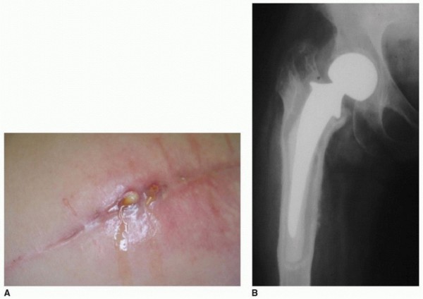 Illustration of pji of the hip - Dr. Mohammed Hutaif