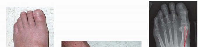 Illustration 5 for Regain Mobility: Surgical Solutions for Charcot Foot Arthropathy