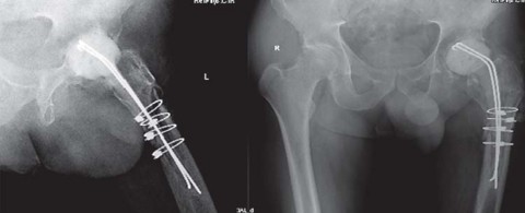 Illustration 9 for Optimizing Outcomes: Two Stage Revision for Infected Total Hip Replacement