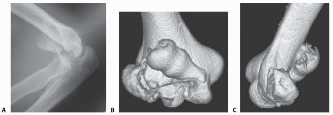 Illustration 5 for Navigating Capitellum and Capitellar-Trochlear Shear Fracture Repair