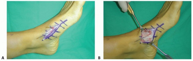Illustration 57 for Mastering Midfoot Arthrodesis: Protect the Deep Neurovascular Bundle