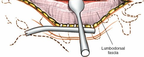 Illustration 9 for Approach to the Lumbar Spine: Mastering Techniques & Anatomy