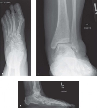 Chronic Foot Pain: Is Debridement of Flexor Digitorum Your Solution?