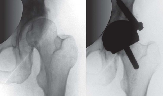 Illustration 7 for Birmingham Hip Resurfacing Designer's Technique for Active Lives