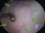 Illustration 14 for Microfracture Chondroplasty: How Tiny Holes Are Made to Fix Cartilage
