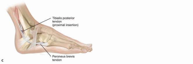 Illustration 2 for Preventing Overcorrection: Split Tibialis Posterior Tendon Transfer