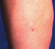 Illustration 16 for Percutaneous Epiphysiodesis: Precisely Closing the Third of the Physis