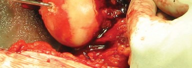 Illustration 39 for Figure Hip Resurfacing: Who Benefits and Who Should Avoid It?