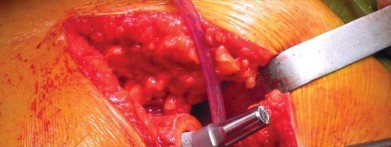 Illustration 46 for Unlock better THA: The technique of short stem for less invasiveness