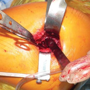 Illustration 39 for Exploring the Ambulatory Surgical Setting for Total Hip Replacement