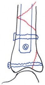 Illustration 9 for Tibial Fracture Extending into the Plafond: Intramedullary Secrets