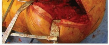 Illustration 18 for Extended Trochanteric Osteotomy: How et al Extended Revision THA Solutions