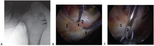 Illustration 138 for Periarticular Arthroscopy: Addressing Medius & Minimus Tears