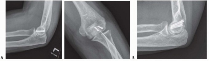 Illustration 8 for Navigating Capitellum and Capitellar-Trochlear Shear Fracture Repair