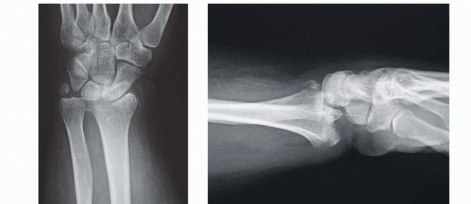 Illustration 26 for Fragment-Specific Fixation: Restore Carpal Facet Horizon