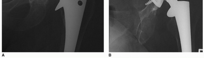 Illustration 2 for Osteolysis Solved: Polyethylene Liner Exchange for Well-Fixed Components