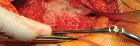 Illustration 46 for Direct Lateral Hip: Optimize Exposure with Sharp Curved Hohmann