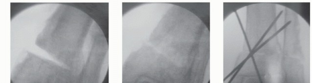 Illustration 5 for Unlock Ankle Preservation: Supramalleolar Closing Wedge Osteotomy