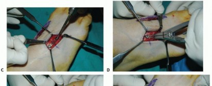 Illustration 29 for Mastering Midfoot Arthrodesis: Protect the Deep Neurovascular Bundle