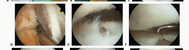 Navigating the posterior calcaneal facet in Subtalar Arthroscopy