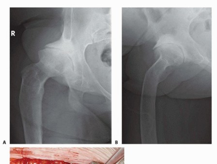 Illustration 36 for Special THA Techniques for Severe Deformities Around the Hip