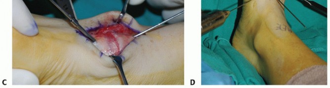 Illustration 13 for Mastering Midfoot Arthrodesis: Protect the Deep Neurovascular Bundle