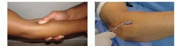 صورة توضيحية لـ متلازمة النفق الكعبري: دليل شامل للمرضى لاستعادة راحة يدك وذراعك