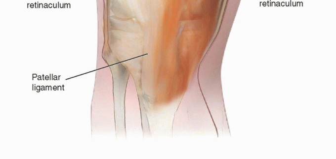 Illustration 3 for Correcting Stiffness in Revision TKA: Achieve Appropriate External Rotation