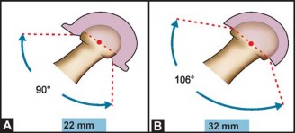 Illustration 20 for Mastering Hip Arthroplasty: Its Evolution and Design Unveiled