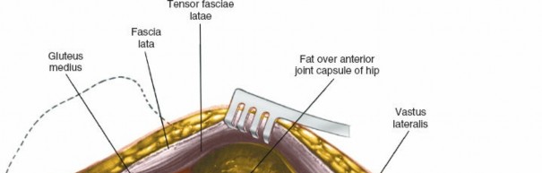 Illustration 107 for Unlocking Every Aspect of the Hip's Surgical Approaches