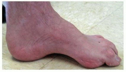 Surgical Strategies to Correct Cavus Foot Deformity
