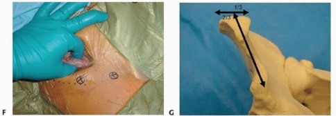 Illustration 17 for Emergency Fixation of the Pelvis: Control Bleeding & Restore Stability