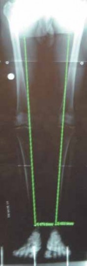 Illustration 5 for Microfracture Chondroplasty: How Tiny Holes Are Made to Fix Cartilage
