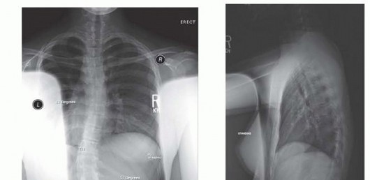 Anterior Interbody Arthrodesis for Scoliosis: What You Need to Know