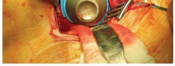 Illustration 8 for Cemented Acetabular Component: Achieving Optimal THA Stability