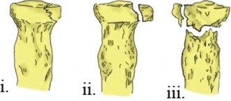 Illustration 3 for Radial Head Fracture: Symptoms, Diagnosis, and Surgical Indications