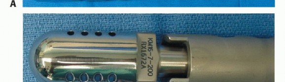 Illustration 4 for Mastering Hip Disarticulation: Through the Hip Joint Capsule