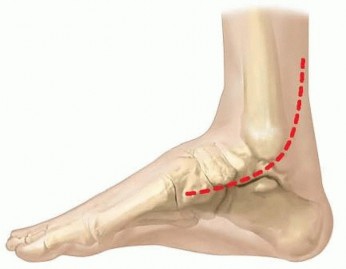 Illustration 5 for Resistant Clubfoot Solved: Posteromedial and Posterolateral Release