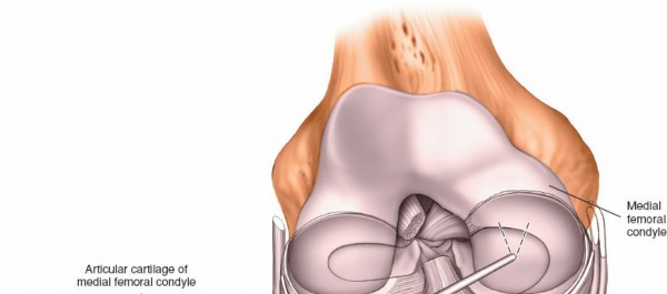 Illustration 14 for Mastering Knee Arthroscopy Approaches: Safely Withdraw the Arthroscope