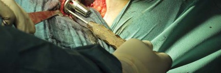 Illustration 68 for Collum Femoris Preserving: Achieve Better Primary Hip Outcomes