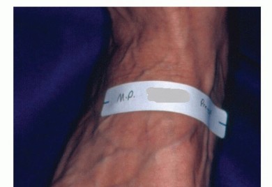 Rheumatoid Forefoot Reconstruction: Regain Mobility & Comfort