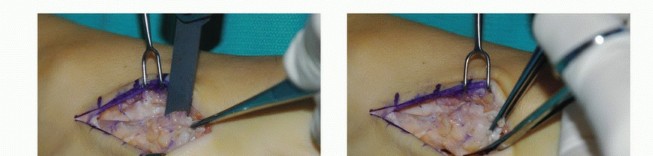 Illustration 5 for Foot Drop Surgery: How a Pin or Drill Elevates Tendon Transfer