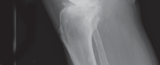 Illustration 5 for Cemented TKA Figure: Your Visual Guide to Surgical Success