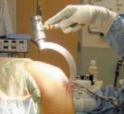 Illustration 28 for Knee Arthroplasty Unicondylar: Discover if Partial Knee Replacement is Right